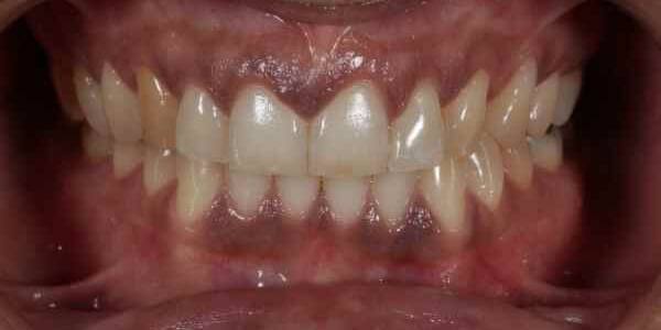 Encías Negras Causas Y Tratamiento Clínica Dental Dobleese 4858