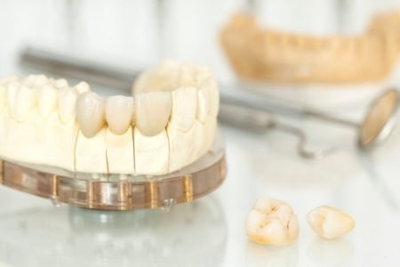 poner dientes sin implantes alternativas al implante dental