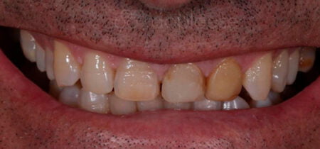 dientes-antes-despues-carillas-sevilla