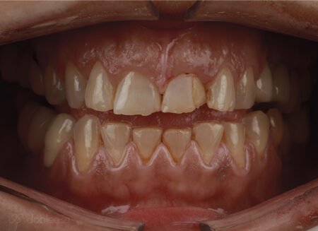 coronas-dentales-sevilla
