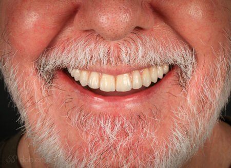 implante dental con poco hueso