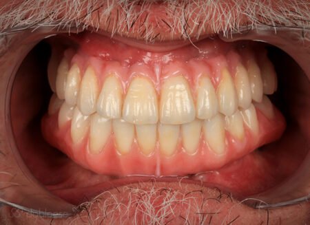 implante dental infectado clinica en sevilla