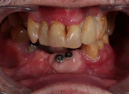 implante dental infectado clinica sevilla