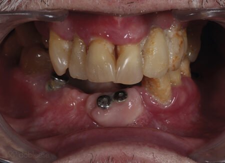 implantes-dentales-24-horas-sevilla