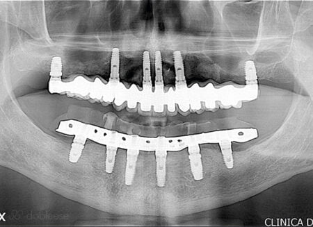 implantes-dentales-inmediatos-sevilla