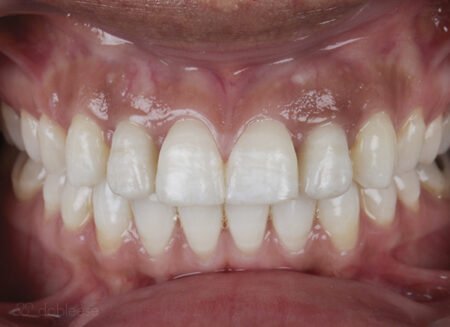 ortodoncia-adultos-sevilla