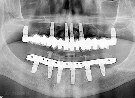 tratamiento-implante-dental-infectado-sevilla
