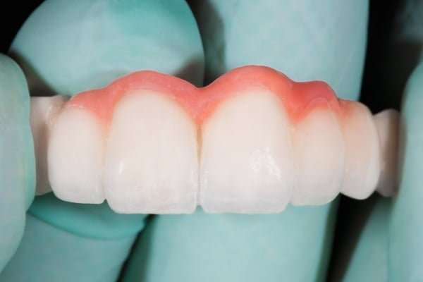 Cuántas veces puedo utilizar el pegamento de prótesis dentales?