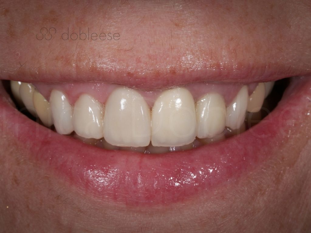 Carillas dentales: tipos, ventajas y precios