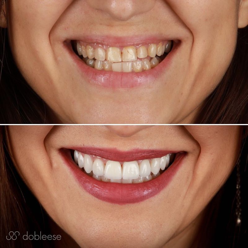 Carillas Dentales: todo lo que debes saber para mejorar el aspecto de tu  sonrisa 