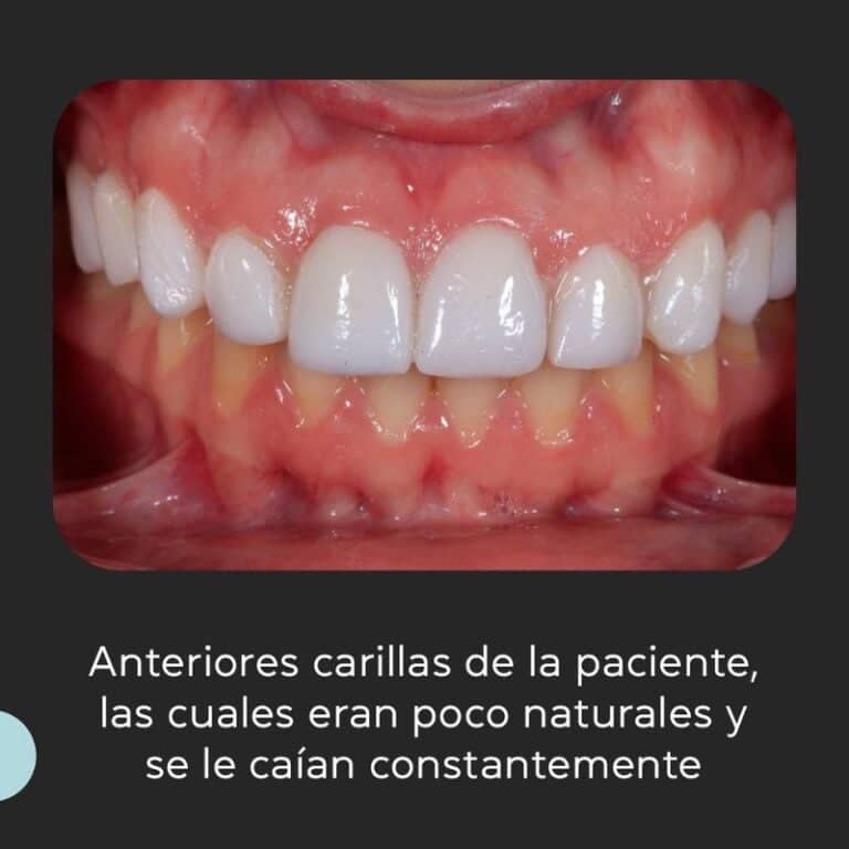 Carillas dentales de porcelana