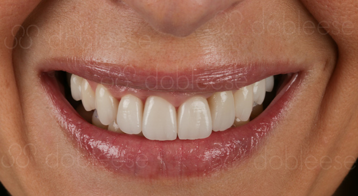 Sonrisa con carilla dental