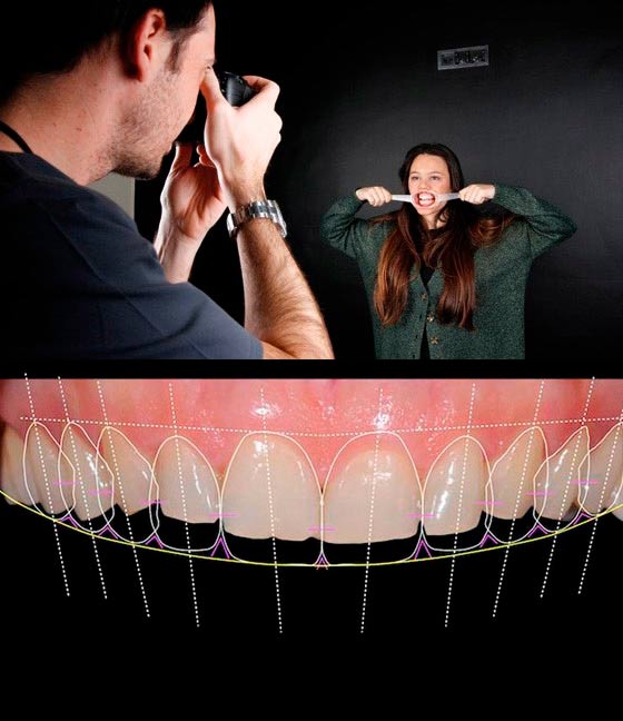 Cómo se colocan las carillas dentales