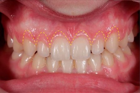 Corrección de sonrisa gingival