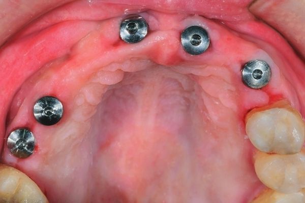 Tipos de dentadura postiza fija