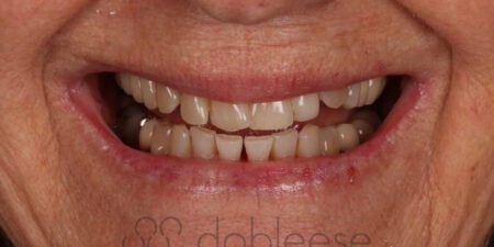 Dientes amarillos: causas y soluciones