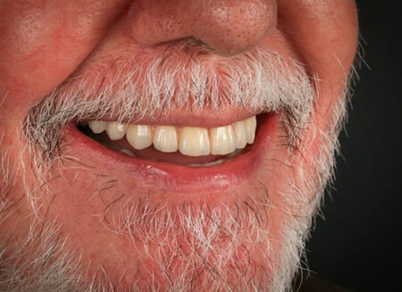 Implantes dentales con poco hueso en Sevilla