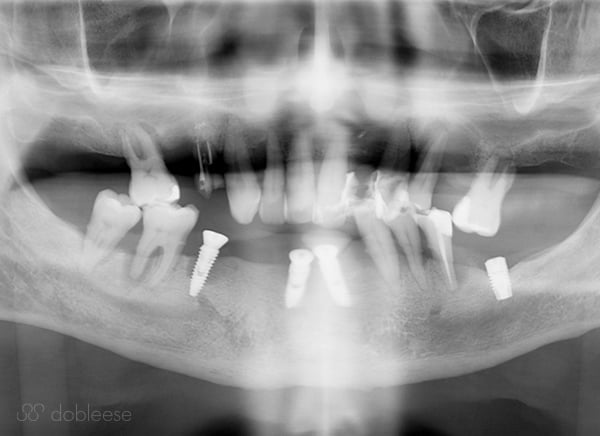 Implantes dentales infectados en Sevilla