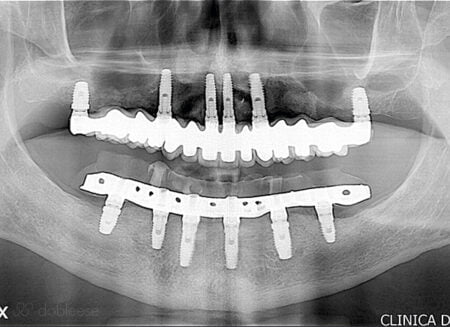 Implante dental 24 horas en Sevilla Paso 4