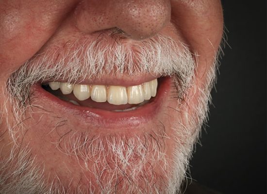 Implantes dentales de carga inmediata