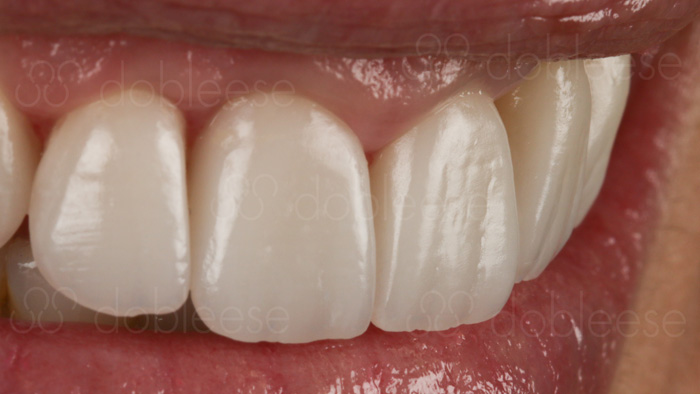 Dentadura con carilla dental