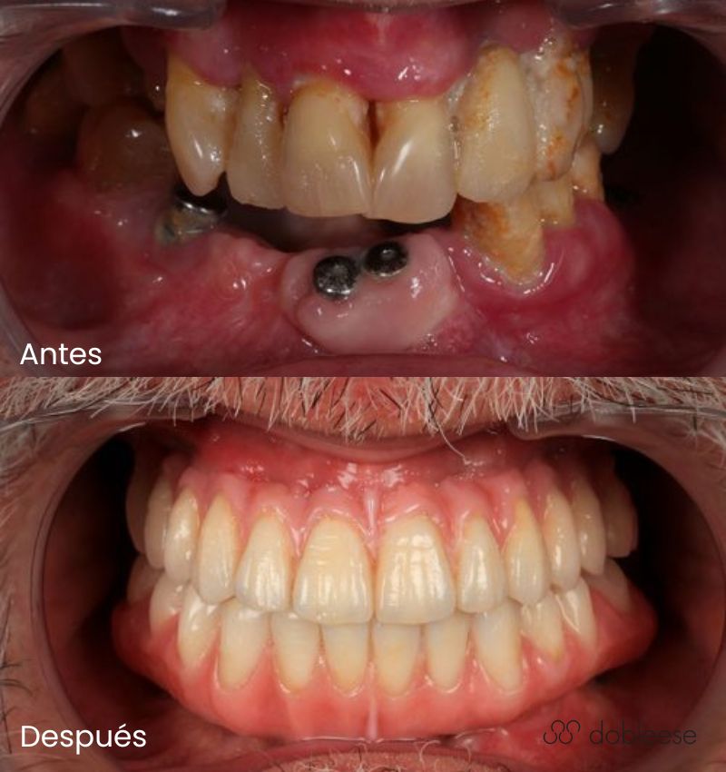 periodontitis cura