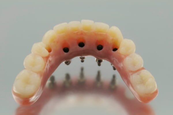 Prótesis dental fija sobre implantes