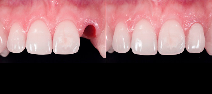 Tiempo de cirugía implantes dentales