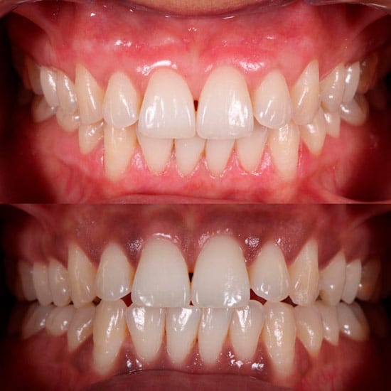 Resultado del tratamiento de encías oscuras en Clínica Dental Dobleese Resultado del tratamiento de encías oscuras en Clínica Dental Dobleese