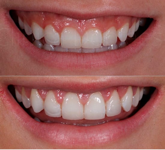 Resultado en los días posteriores al remodelado de la encía en Clínica Dental Dobleese Resultado en los días posteriores al remodelado de la encía en Clínica Dental Dobleese