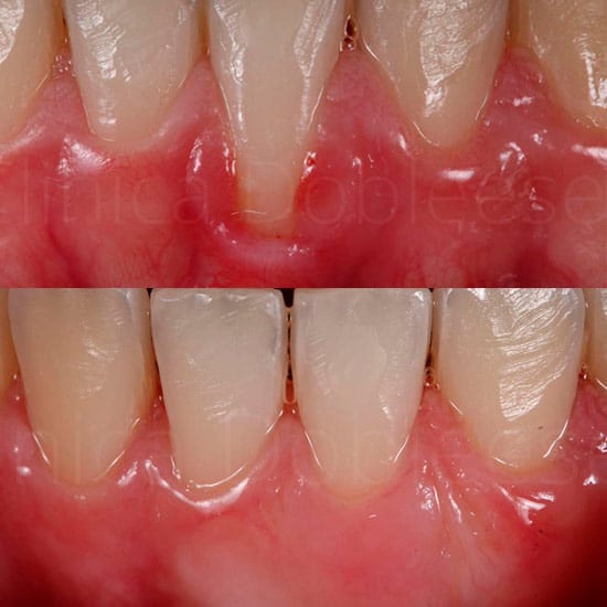 Resultado del tratamiento de encías retraídas mediante cirugía plástica mucogingival en Clínica Dental Dobleese Resultado del tratamiento de encías retraídas mediante cirugía plástica mucogingival en Clínica Dental Dobleese
