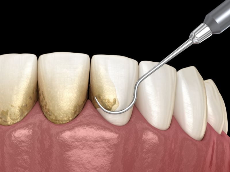 tratamiento periodontitis