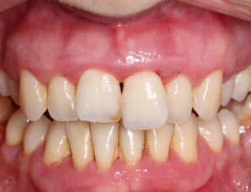 Qué son las Bolsas Periodontales, tipos, fotos y tratamiento