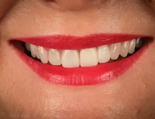 ¿Se pueden poner carillas con los dientes torcidos?