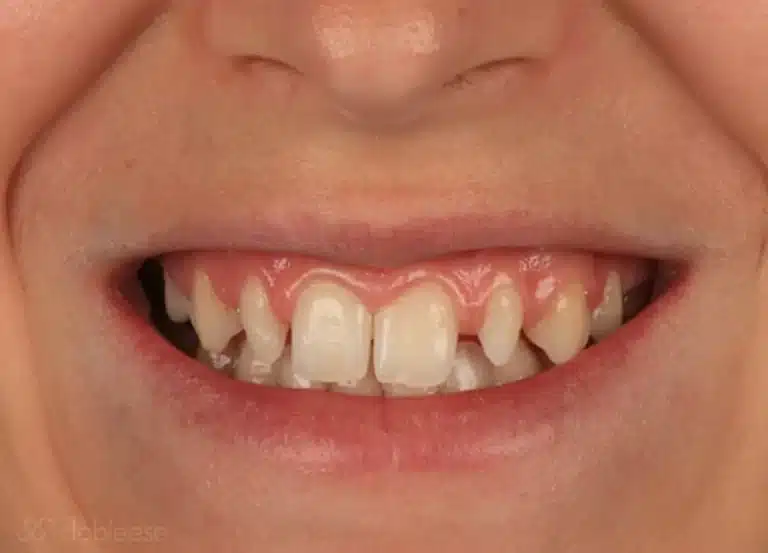 causas del apiñamiento dental