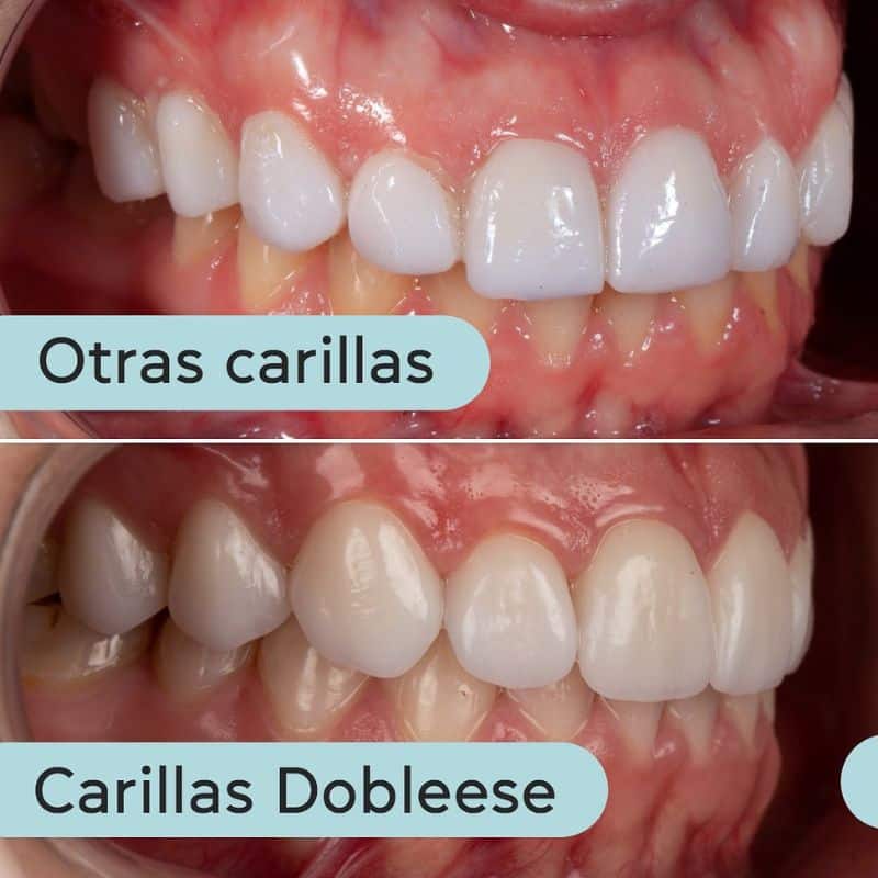 Qué son las carillas de porcelana para los dientes