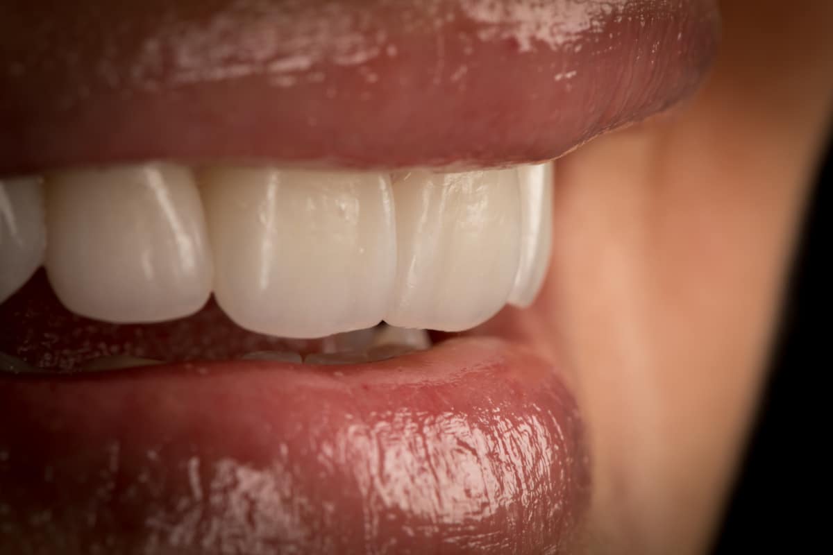 Colocación proceso colocación carillas dentales Colocación proceso colocación carillas dentales
