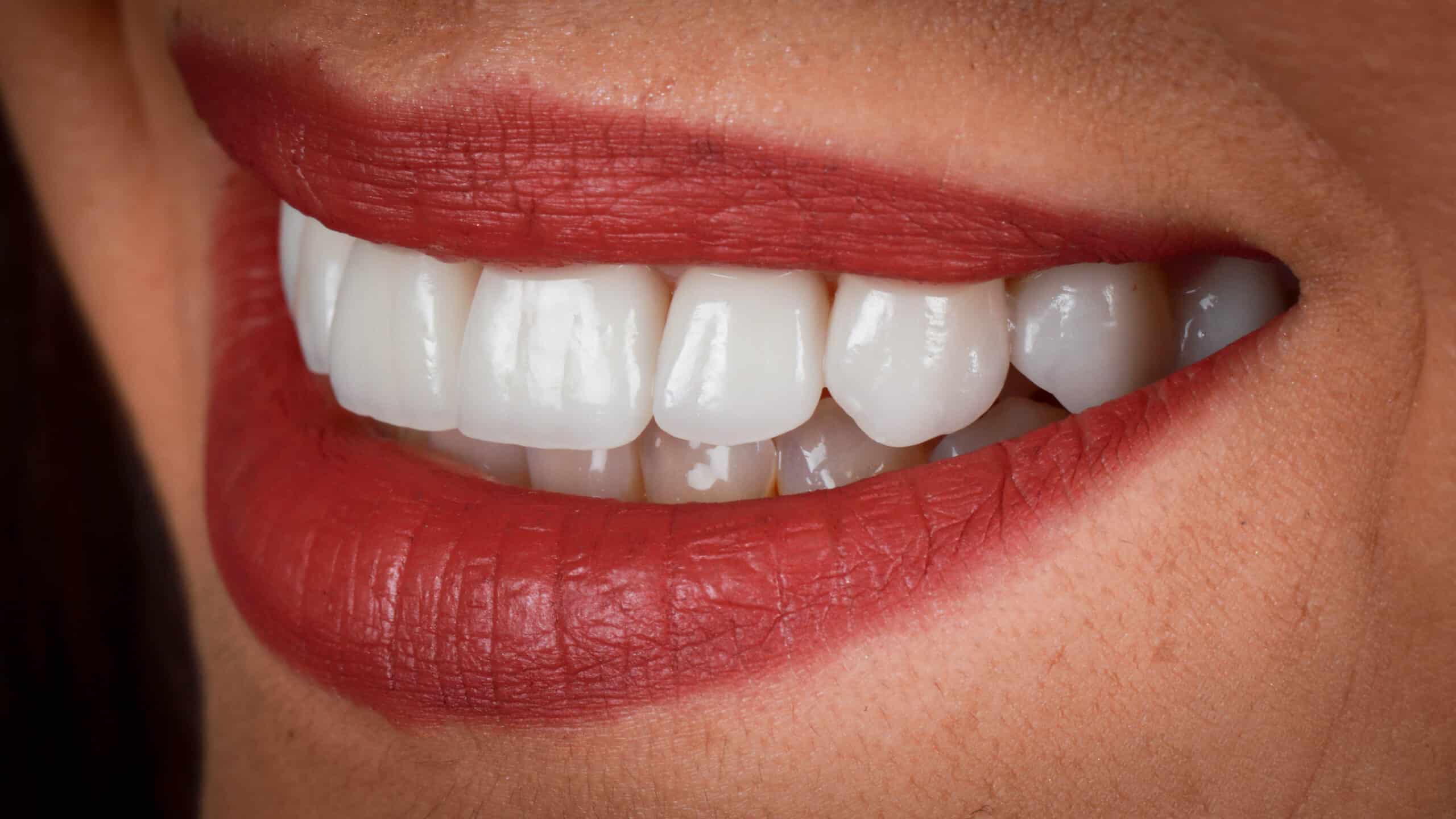 Sonrisa con carillas dentales