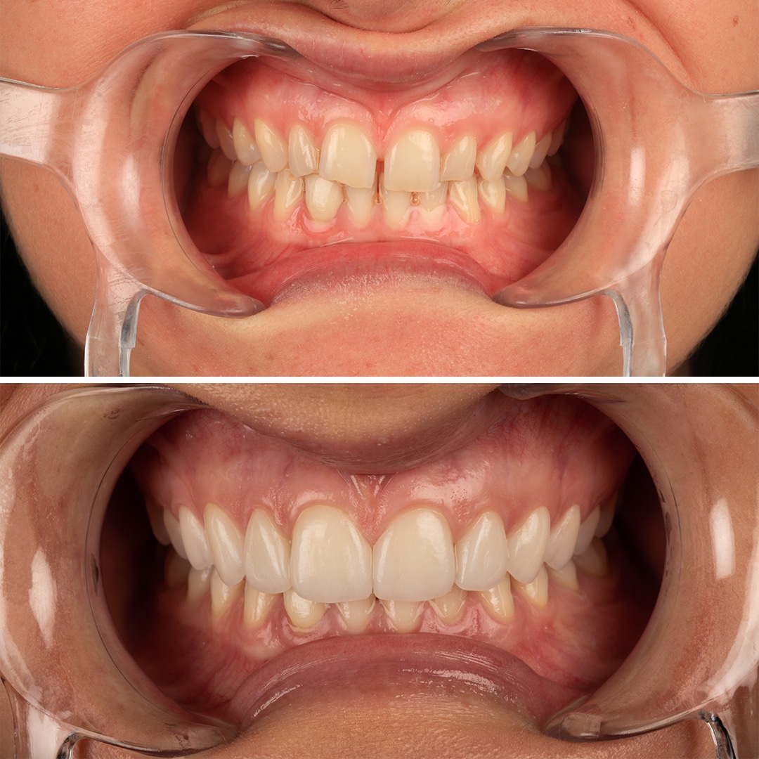 Fotos de antes y después de tratamientos de carillas dentales