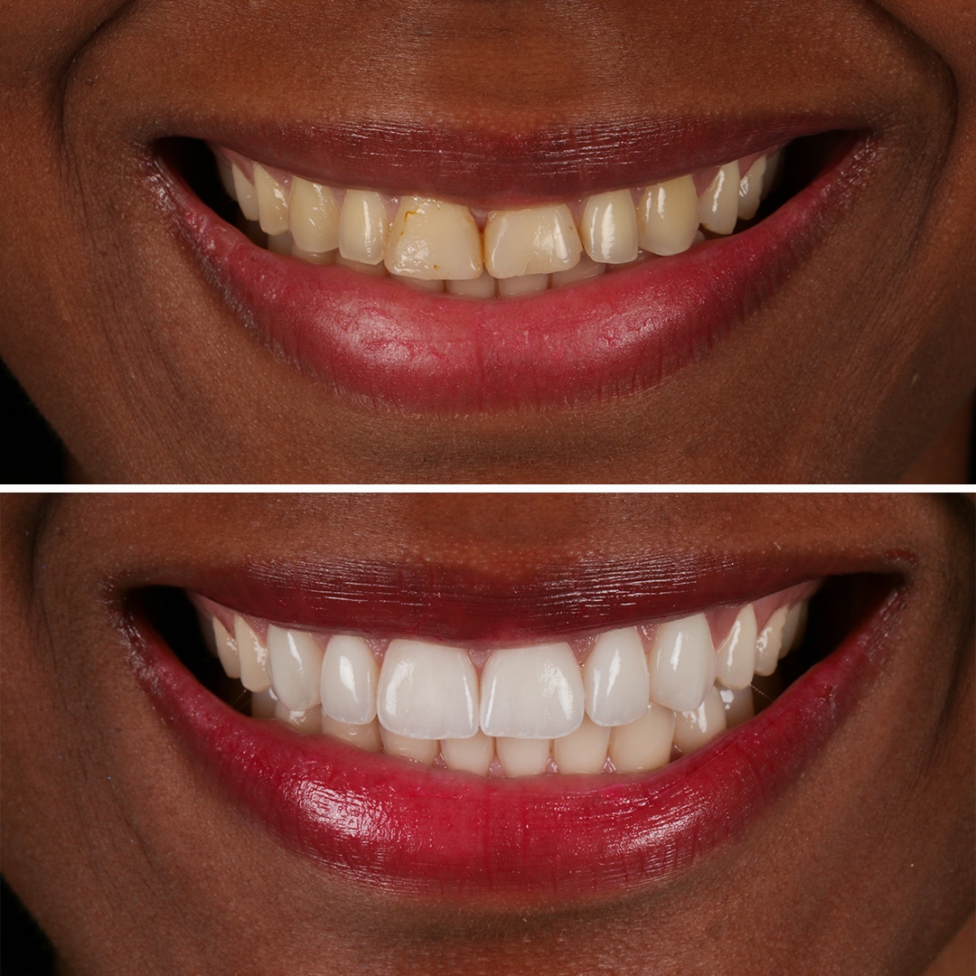 Fotos de antes y después de tratamientos de carillas dentales