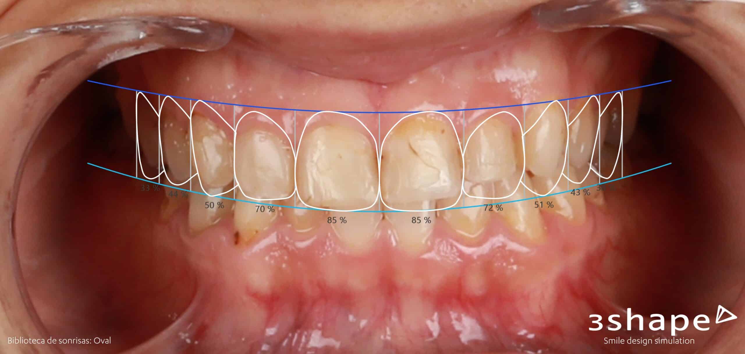 Evaluación inicial proceso colocación carillas dentales Evaluación inicial proceso colocación carillas dentales