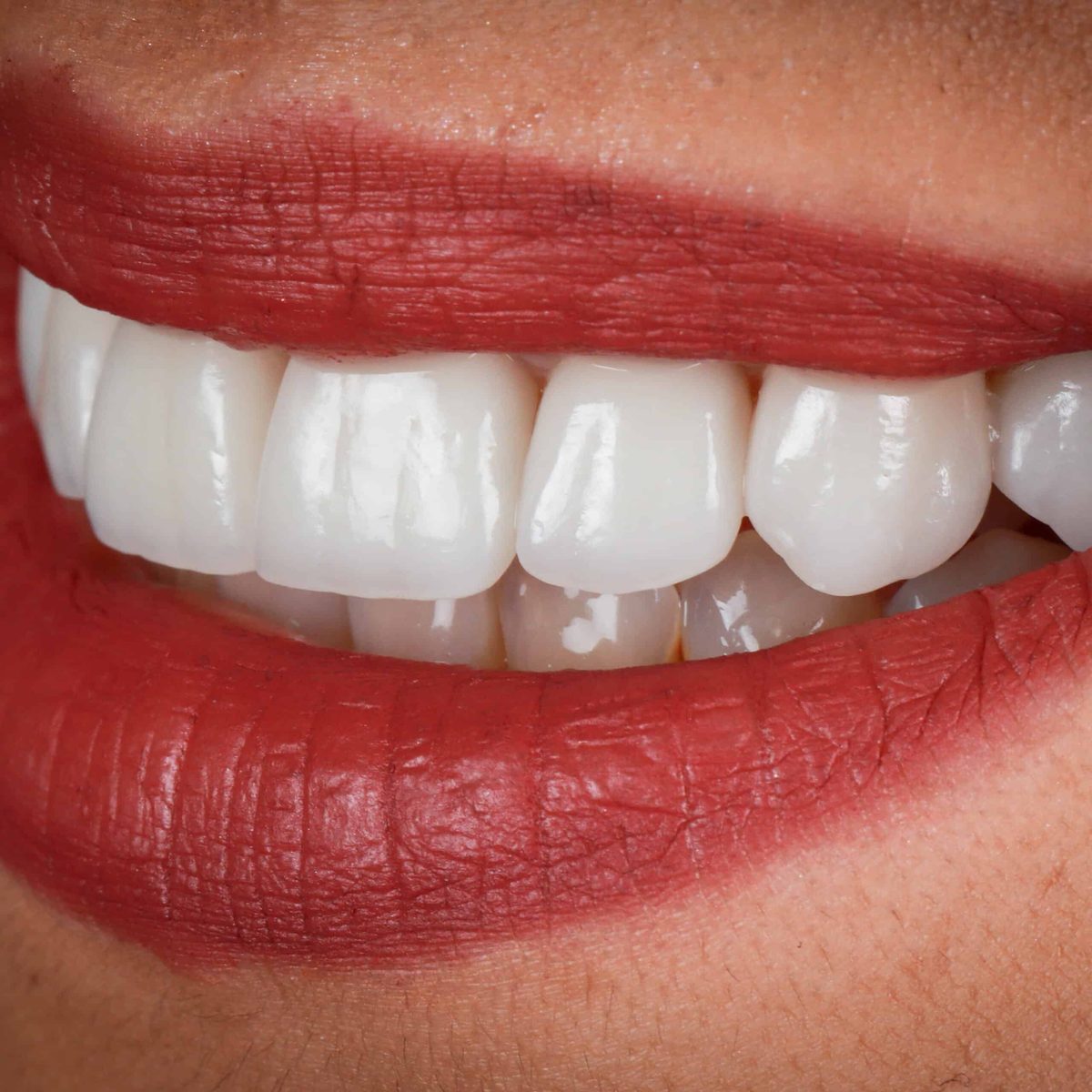 Sonrisa carillas dentales