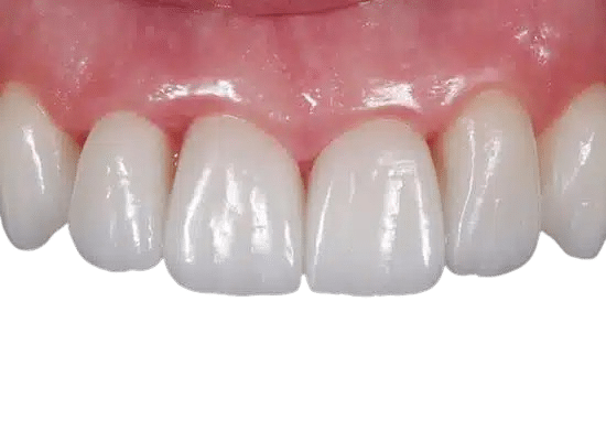 _Qué_beneficios_tiene_la_terapia_de_láser_dental_frente_a_los_tratamientos_tradicionales_-removebg-preview