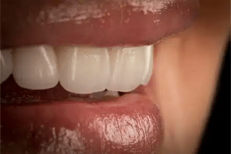 ¿Qué es y en qué consiste un tratamiento de láser dental_