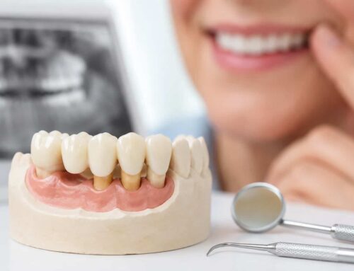 Todo sobre la adaptación a la prótesis dental fija