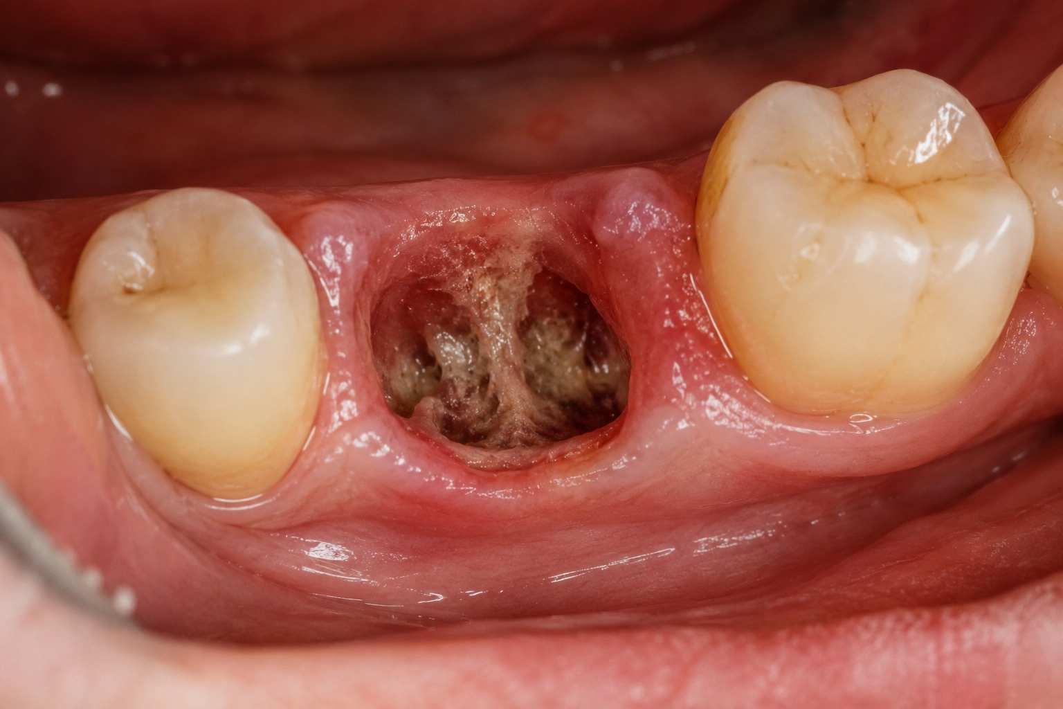 Alveolitis dental