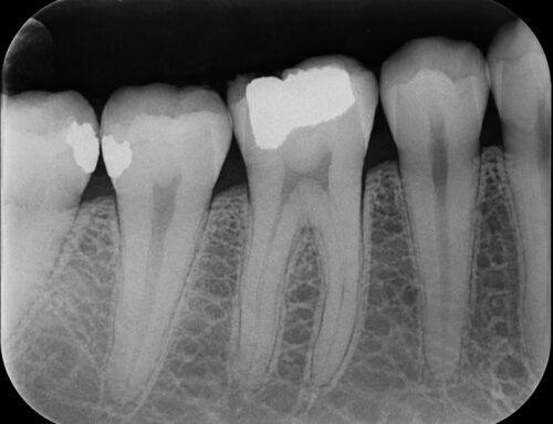 Radiografía periapical: qué es, para qué sirve y cómo se realiza