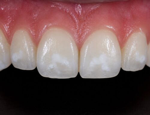 Qué son y cómo eliminar las caries blancas