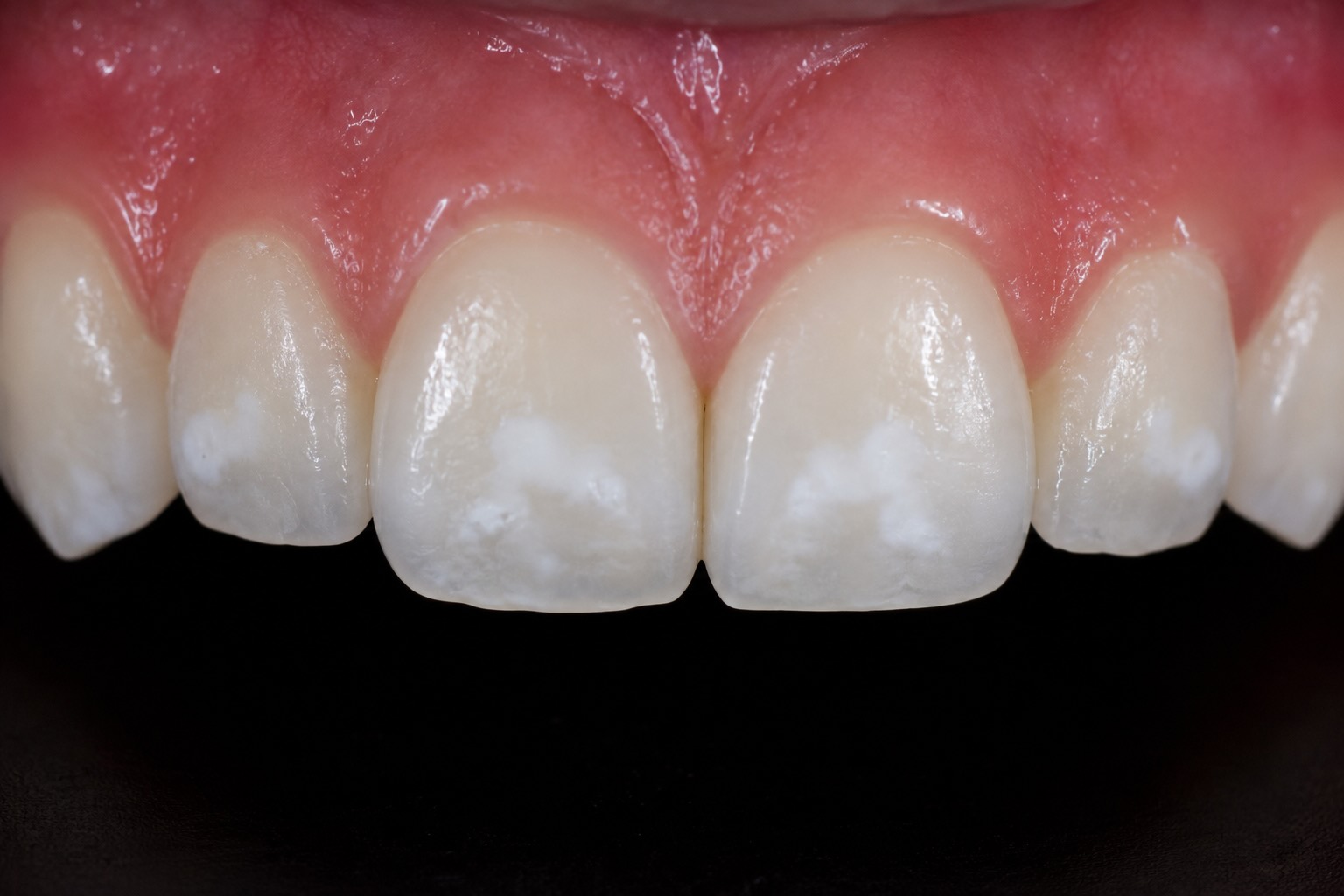 caries blanca