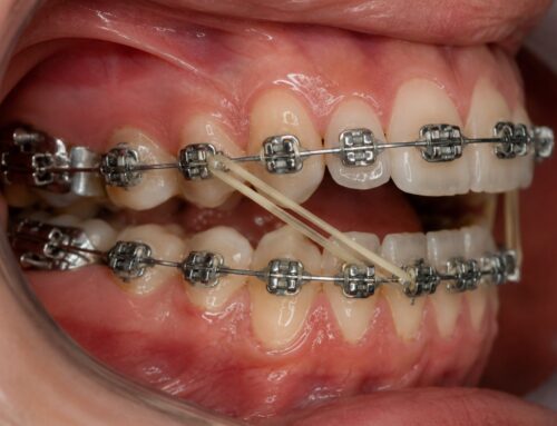Para qué sirven las gomas de los brackets y cómo usarlas